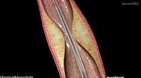 Cirug&iacute;a Intervencionista Cardiovascular