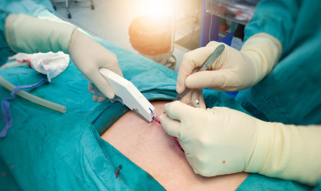 Instrumento quirúrgico médico grapadora de piel desechable para sutura de heridas