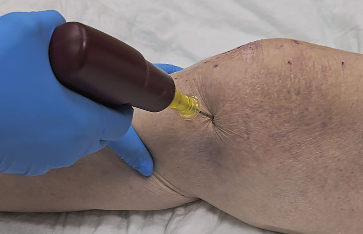 infusi&oacute;n intra&oacute;sea2.jpg