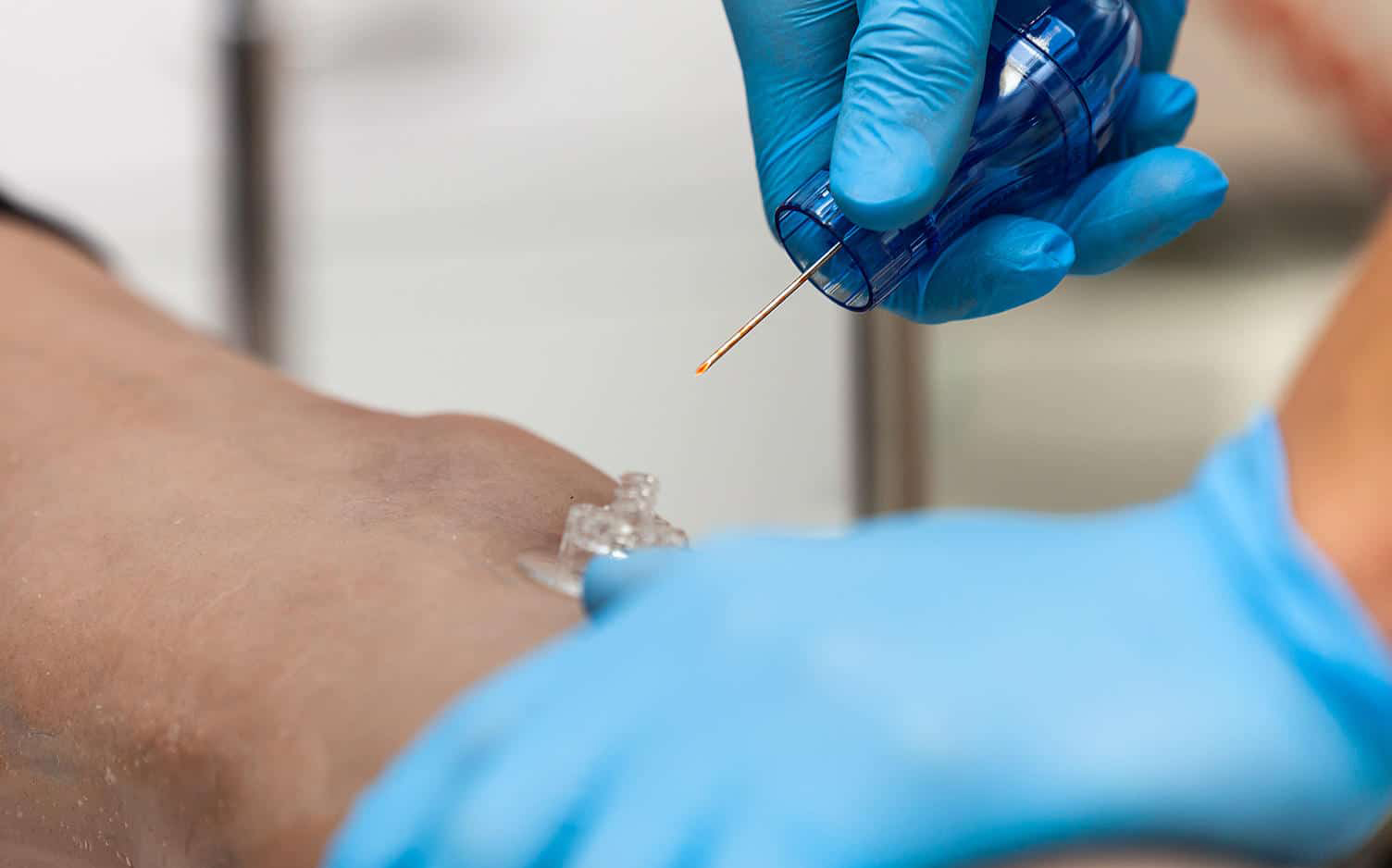 infusi&oacute;n intra&oacute;sea3.jpg
